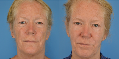 Dermal Fillers before and after photo