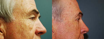 Eyelid Surgery before and after photo