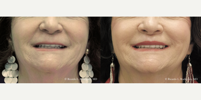 Lip Lift before and after photo