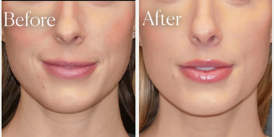 Lip Lift before and after photo
