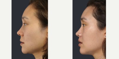 Lip Lift before and after photo