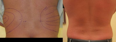 Liposuction before and after photo