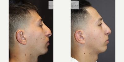 Rhinoplasty before and after photo