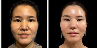 Rhinoplasty before and after photo