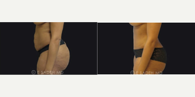 Tummy Tuck before and after photo