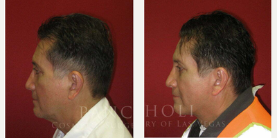 Facelift before and after photo