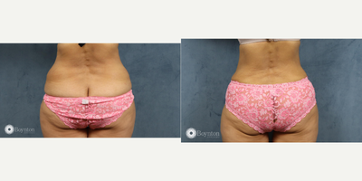 Mommy Makeover before and after photo
