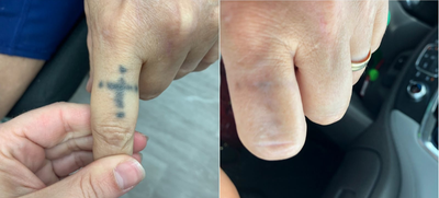 PicoSure before and after photo