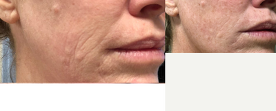 Ultherapy before and after photo