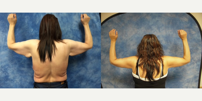 Arm Lift before and after photo