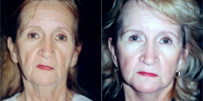 Facelift before and after photo