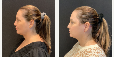 Facelift before and after photo