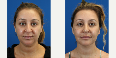 FaceTite before and after photo