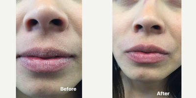 HydraFacial before and after photo