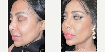 Nonsurgical Facelift before and after photo