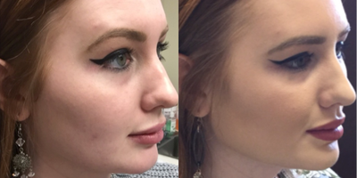 Restylane before and after photo