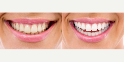Teeth Whitening before and after photo
