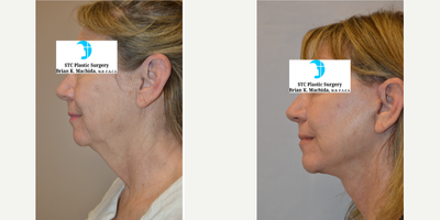 Deep Plane Facelift before and after photo
