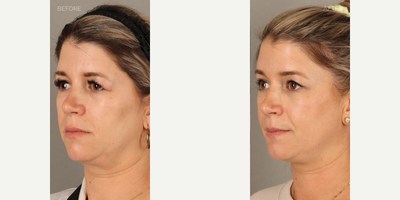 Eyelid Surgery before and after photo