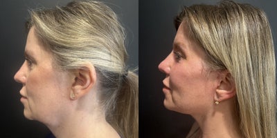 Facial Fat Transfer before and after photo