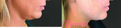 Kybella before and after photo