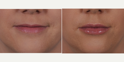 Lip Fillers before and after photo
