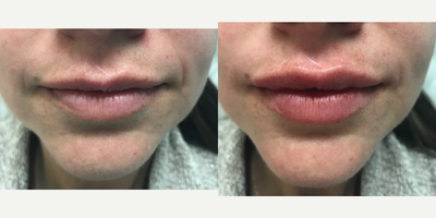 Lip Fillers before and after photo