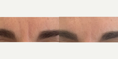 Botox before and after photo