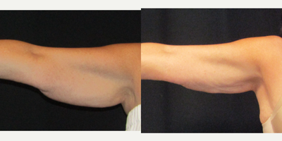 CoolSculpting before and after photo