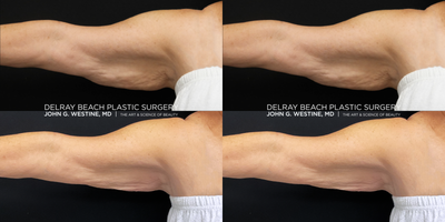 CoolSculpting before and after photo