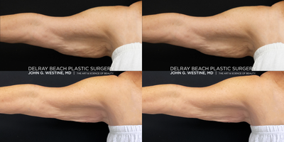 CoolSculpting before and after photo