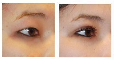Double Eyelid Surgery before and after photo