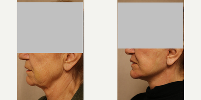 Facelift before and after photo