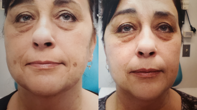 Laser Resurfacing before and after photo