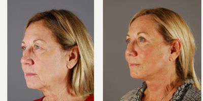 MACS Facelift before and after photo