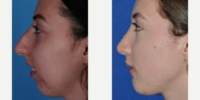 Chin Implant before and after photo