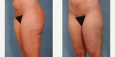 Vaser Liposuction before and after photo