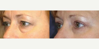 Eyelid Surgery before and after photo