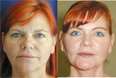 Facelift before and after photo