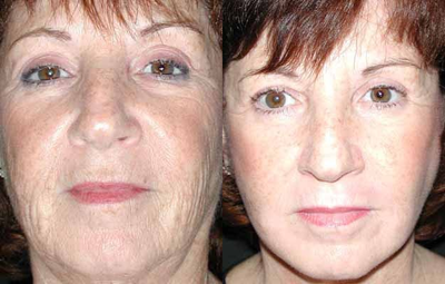 Facelift before and after photo