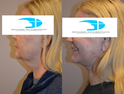 Facelift before and after photo