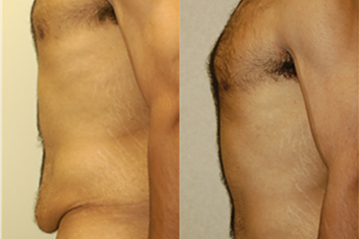 Body Lift before and after photo