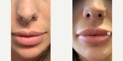 Dermal Fillers before and after photo