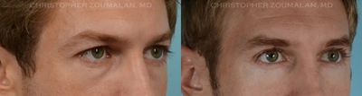 Eyelid Surgery before and after photo
