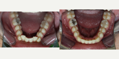 Invisalign before and after photo