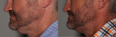 Kybella before and after photo