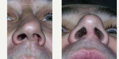 Septoplasty before and after photo
