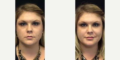 Volbella before and after photo