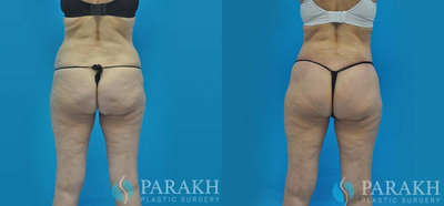 Body Lift before and after photo