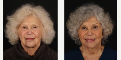 Deep Plane Facelift before and after photo